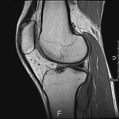 膝関節MRI
